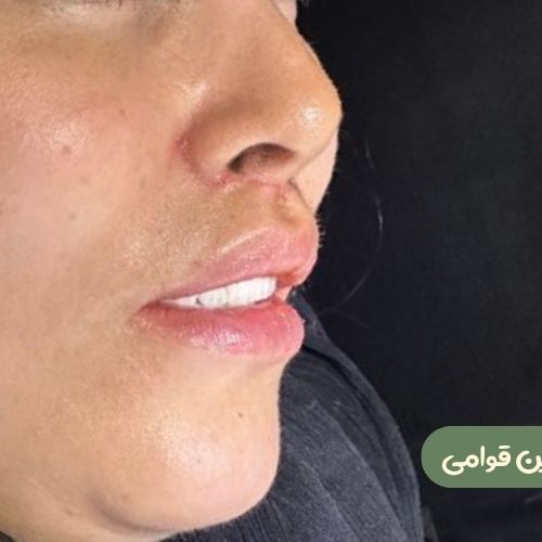 بعد از سانترال لب