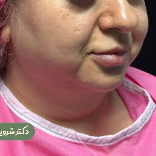 قبل از ژنیوپلاستی + ساکشن غبغب