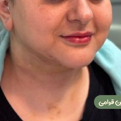 بعد از ژنیوپلاستی + ساکشن غبغب