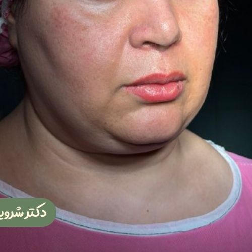 قبل از ژنیوپلاستی + ساکشن غبغب