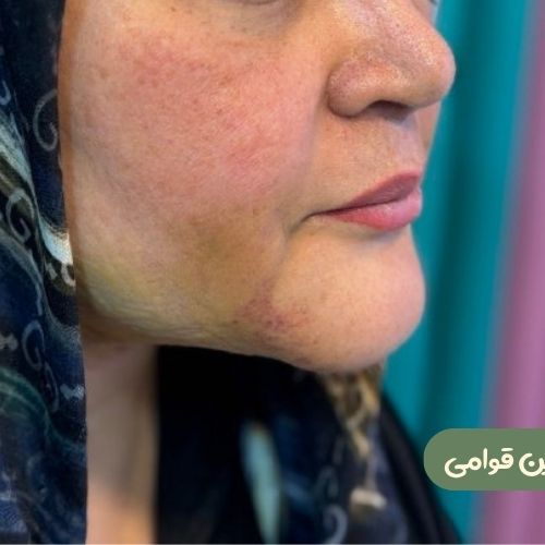 بعد از ژنیوپلاستی + ساکشن غبغب