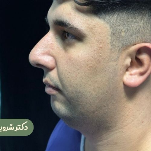 قبل از رینوپلاستی + ژنیوپلاستی + ساکشن غبغب