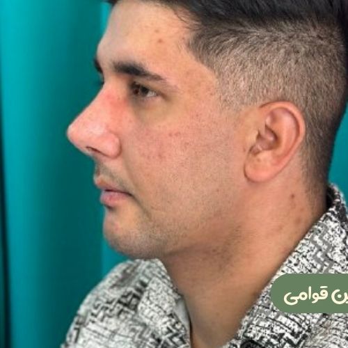 بعد از رینوپلاستی + ژنیوپلاستی + ساکشن غبغب