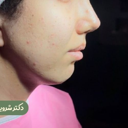 قبل از ژنیوپلاستی