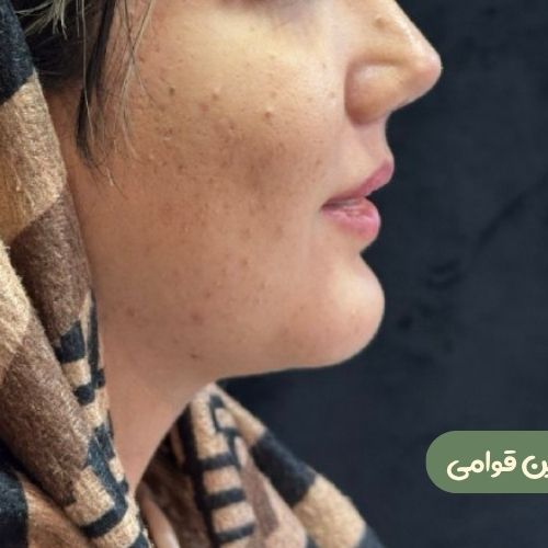 بعد از ژنیوپلاستی