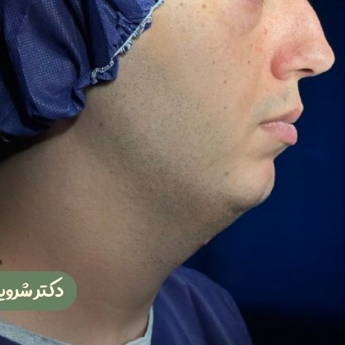 قبل از ژنیوپلاستی + ساکشن غبغب