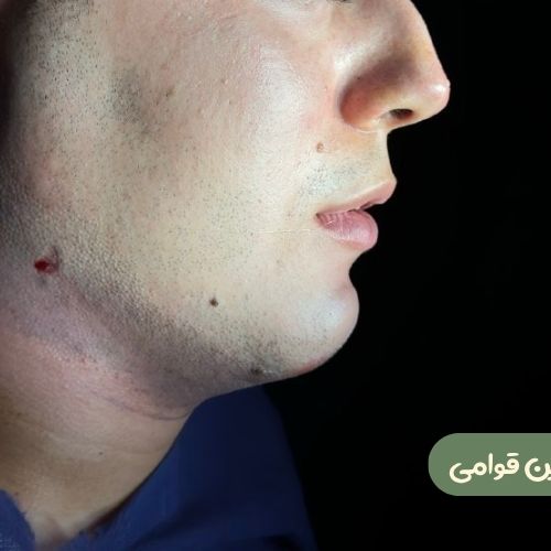 بعد از ژنیوپلاستی + ساکشن غبغب