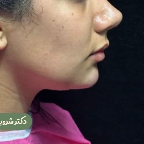 قبل از ژنیوپلاستی