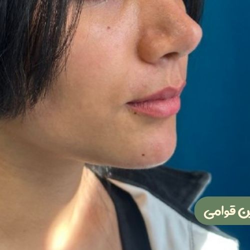 بعد از ژنیوپلاستی
