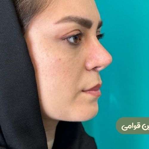 بعد از رینوپلاستی + ژنیوپلاستی