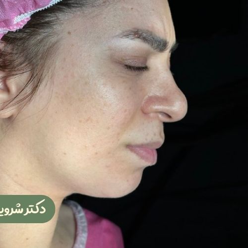 قبل از رینوپلاستی + ژنیوپلاستی