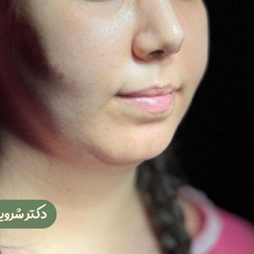 قبل از ژنیوپلاستی