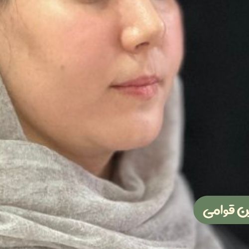 بعد از ژنیوپلاستی