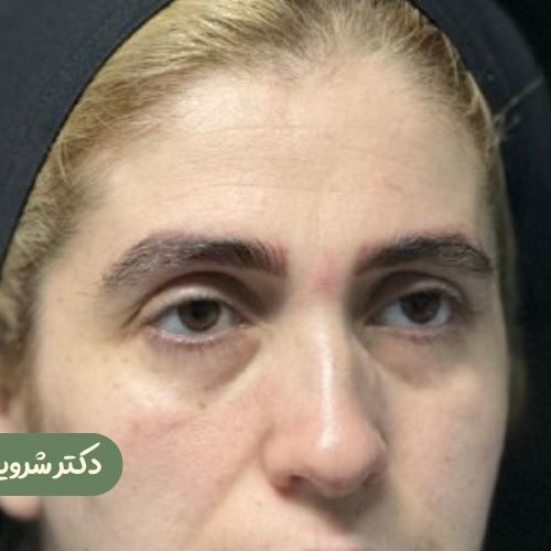 قبل از لیفت شقیقه