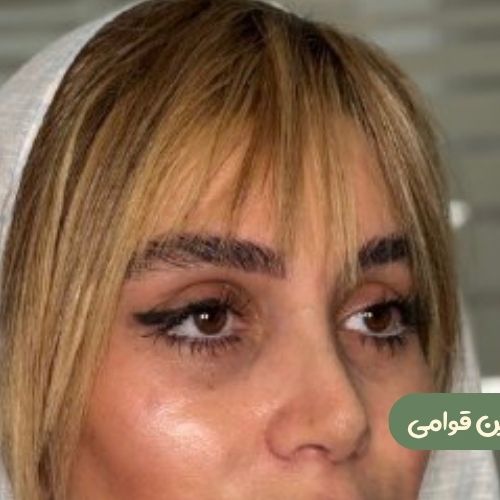 بعد از لیفت شقیقه