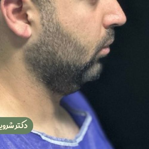 قبل از بوکال فت + ژنیوپلاستی