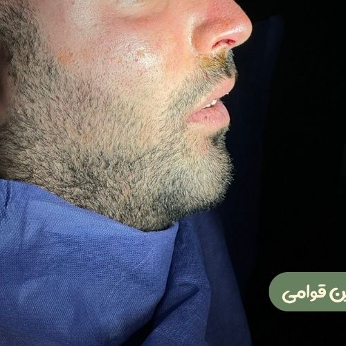 بعد از بوکال فت + ژنیوپلاستی