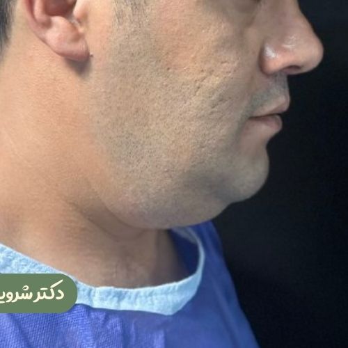 قبل از ژنیوپلاستی + ساکشن غبغب