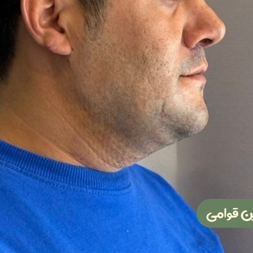 بعد از ژنیوپلاستی + ساکشن غبغب