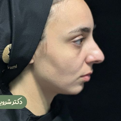 قبل از رینوپلاستی + ژنیوپلاستی