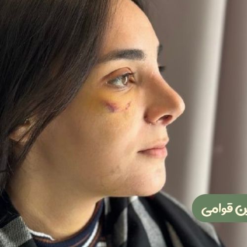 بعد از رینوپلاستی + ژنیوپلاستی