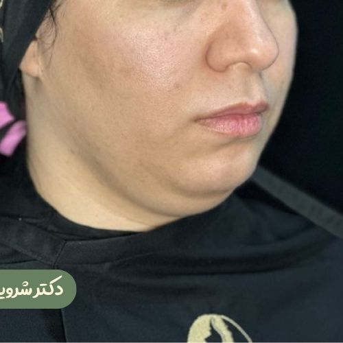قبل از ژنیوپلاستی + ساکشن غبغب