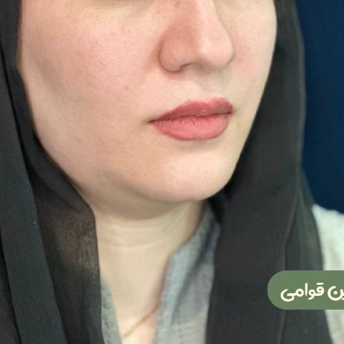 بعد از ژنیوپلاستی + ساکشن غبغب