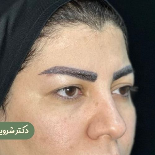 قبل از بلفاروپلاستی
