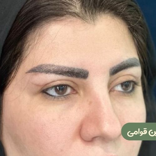 بعد از بلفاروپلاستی