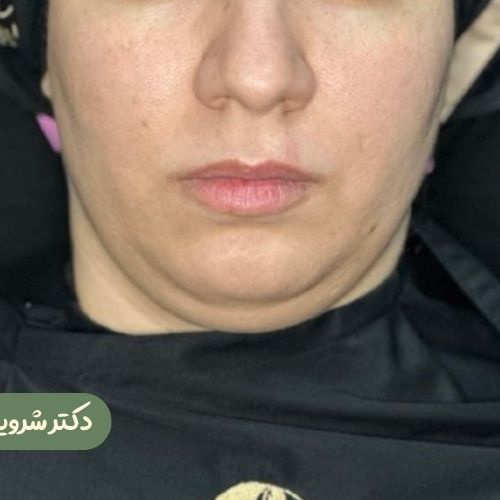 قبل از ژنیوپلاستی + ساکشن غبغب
