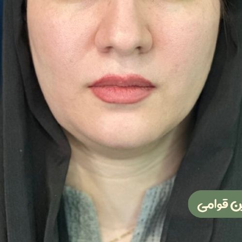 بعد از ژنیوپلاستی + ساکشن غبغب