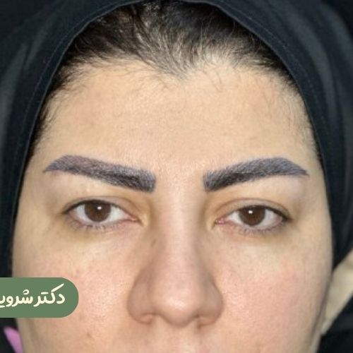 قبل از بلفاروپلاستی
