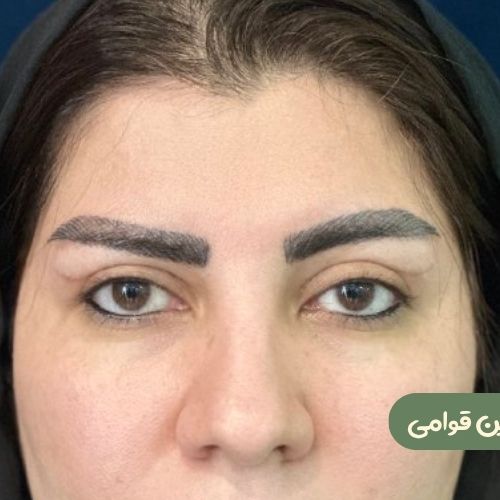 بعد از بلفاروپلاستی