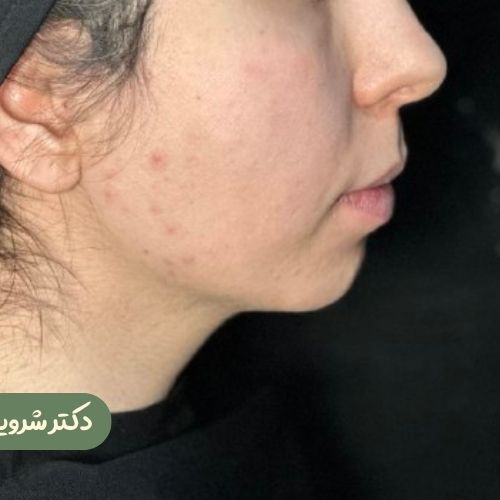 قبل از بوکال فت + ساکشن غبغب + ژنیوپلاستی