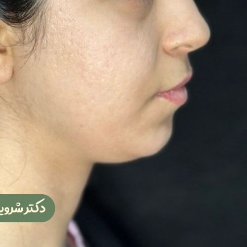 قبل از بوکال فت + ساکشن غبغب + ژنیوپلاستی