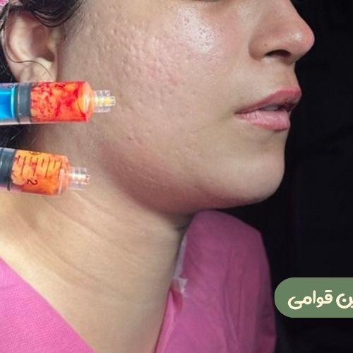 بعد از بوکال فت + ساکشن غبغب + ژنیوپلاستی