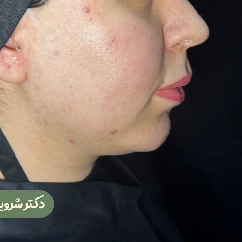قبل از ژنیوپلاستی