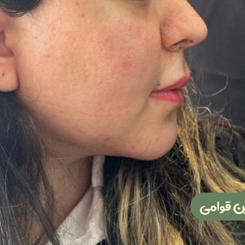 بعد از ژنیوپلاستی