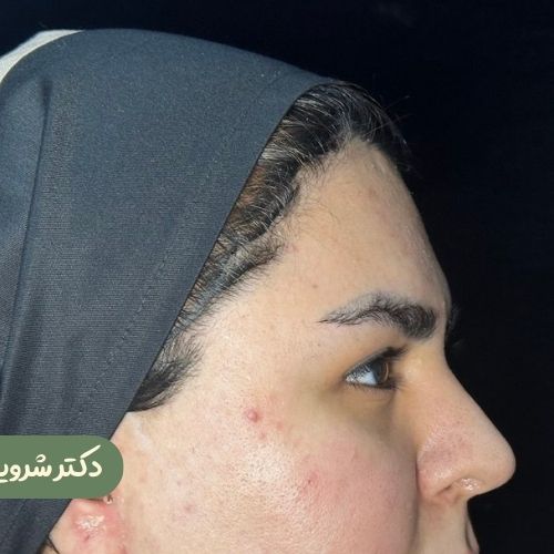 قبل از لیفت شقیقه