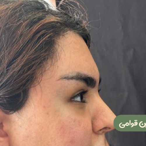 بعد از لیفت شقیقه