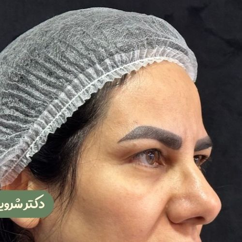 قبل از بلفاروپلاستی + دایرکت ابرو