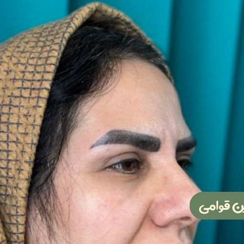 بعد از بلفاروپلاستی + دایرکت ابرو