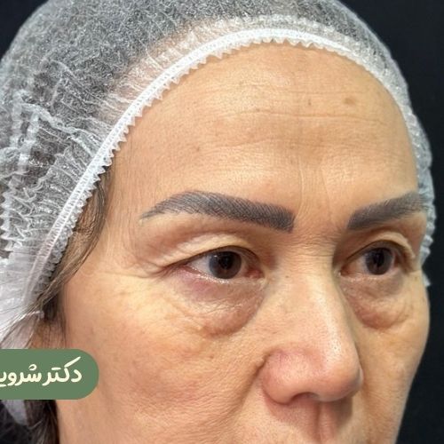 قبل از بلفاروپلاستی + دایرکت ابرو