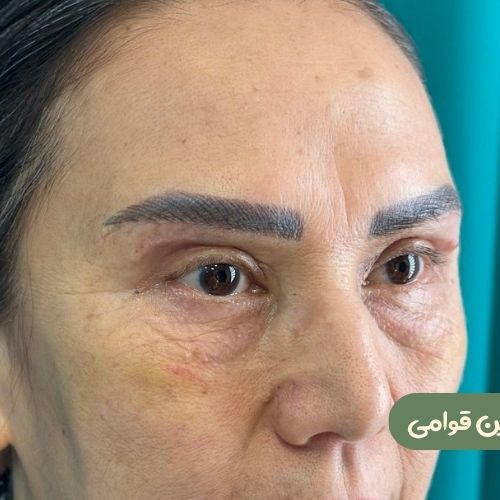 بعد از بلفاروپلاستی + دایرکت ابرو