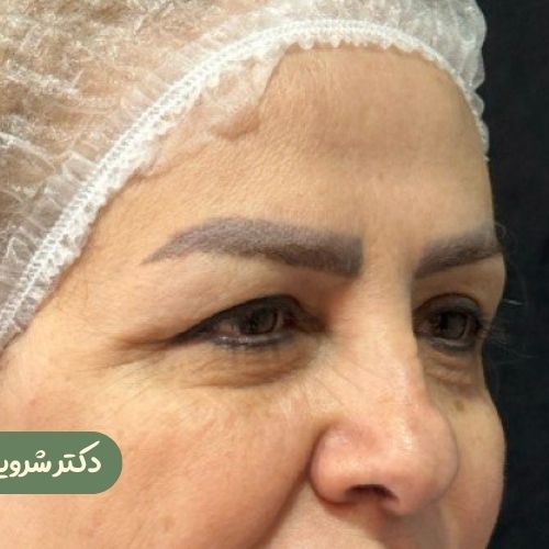 قبل از بلفاروپلاستی + دایرکت ابرو