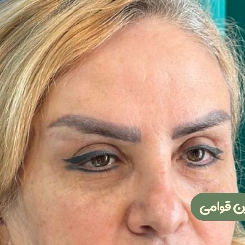 بعد از بلفاروپلاستی + دایرکت ابرو