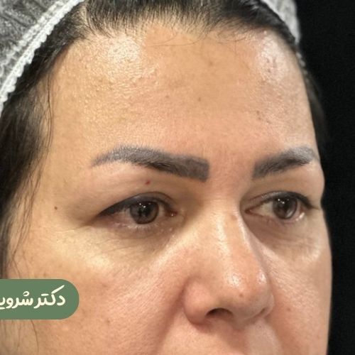 قبل از بلفاروپلاستی + دایرکت ابرو