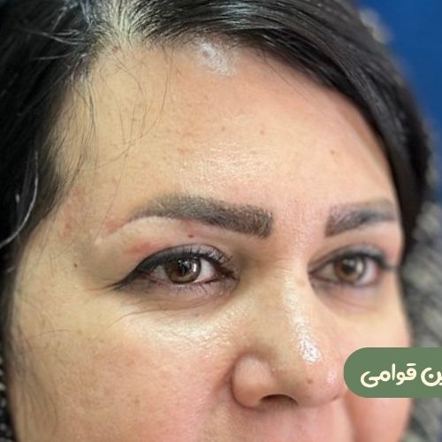 بعد از بلفاروپلاستی + دایرکت ابرو