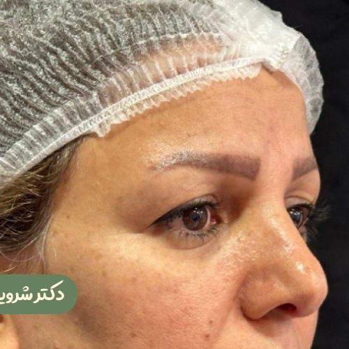 قبل از بلفاروپلاستی + دایرکت ابرو
