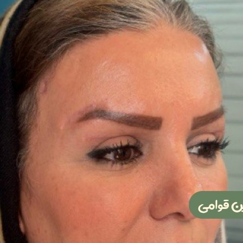 بعد از بلفاروپلاستی + دایرکت ابرو